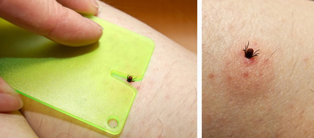 The fast removal of a tick can prevent the transmission of Lyme disease. Photo: Carola Vahldiek/fotolia.com