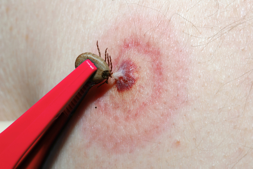 Erythema migrans - the first sign of an infection with Lyme Disease